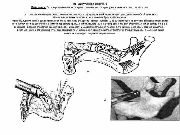Анестезия по гейтсу. Проводниковая анестезия нижней челюсти мандибулярная. Мандибулярная анестезия методика. Торусальная анестезия методика. Проводниковая анестезия нижней челюсти торусальная.