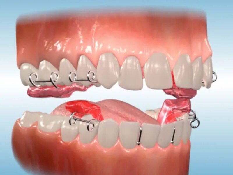 Аппарат твин блок ортодонтия. Двухчелюстной аппарат twin block. Twin block. Ортодонтический аппарат твин блок кларка. Twin block.