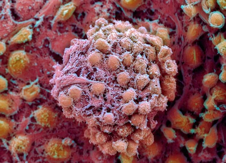 Злокачественная опухоль. Эмбриональная стволовая клетка. Эмбриональные стволовые клетки человека. Фетальные стволовые клетки. 1)Эмбриональные стволовые клетки -.