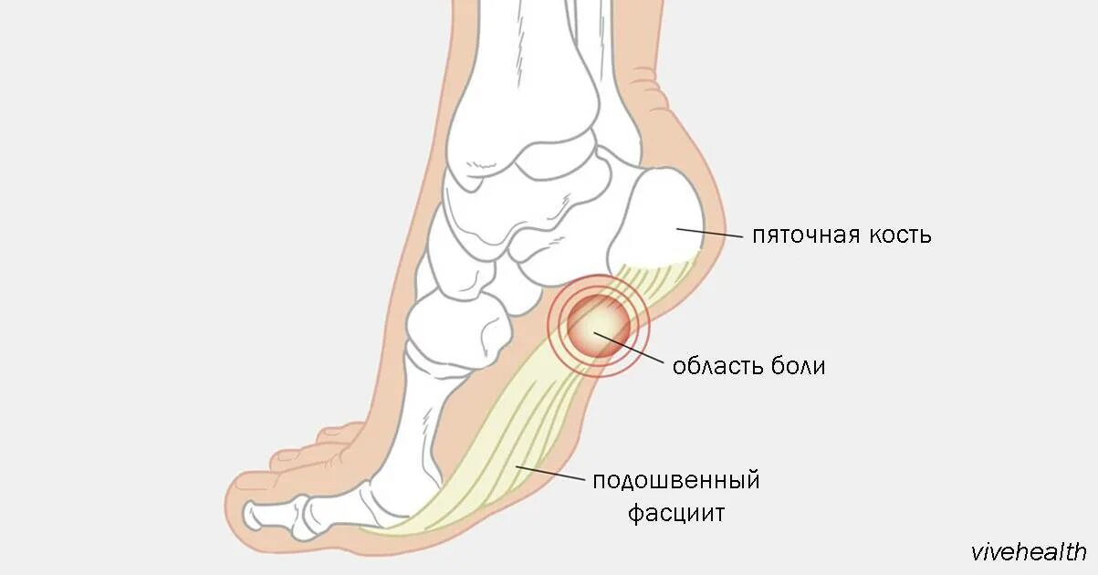 Почему больно ходить. Больно наступать на пятку. Боль при ходьбе в пятке стопы.