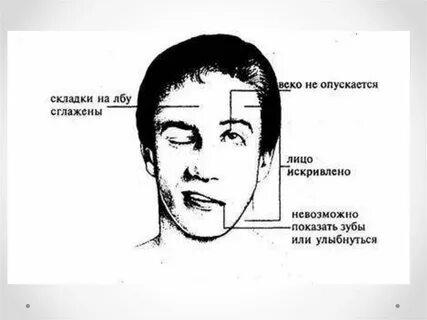 Парализовало левую сторону