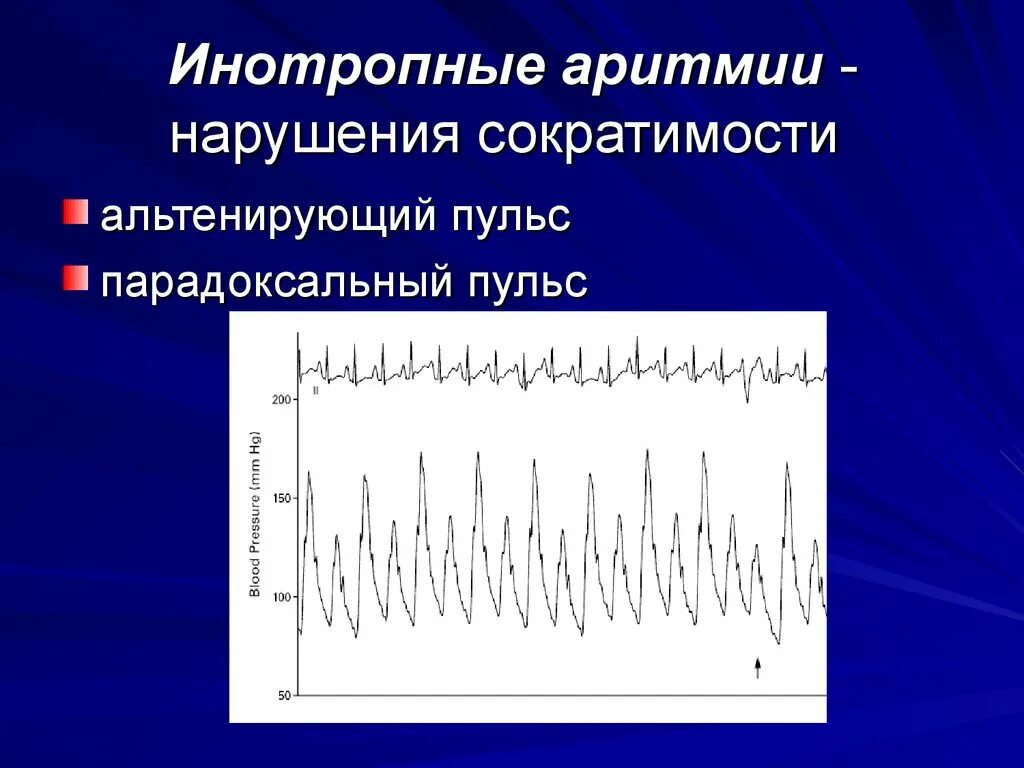 Пульс нарушение ритма