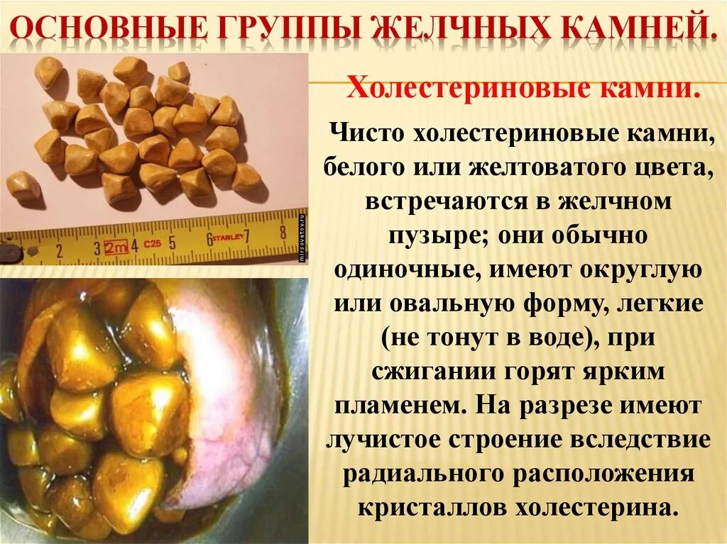 При каком размере камней в желчном. Камни из желчного пузыря. Камен в желичем пузеие. Холестериновые камни в желчном.