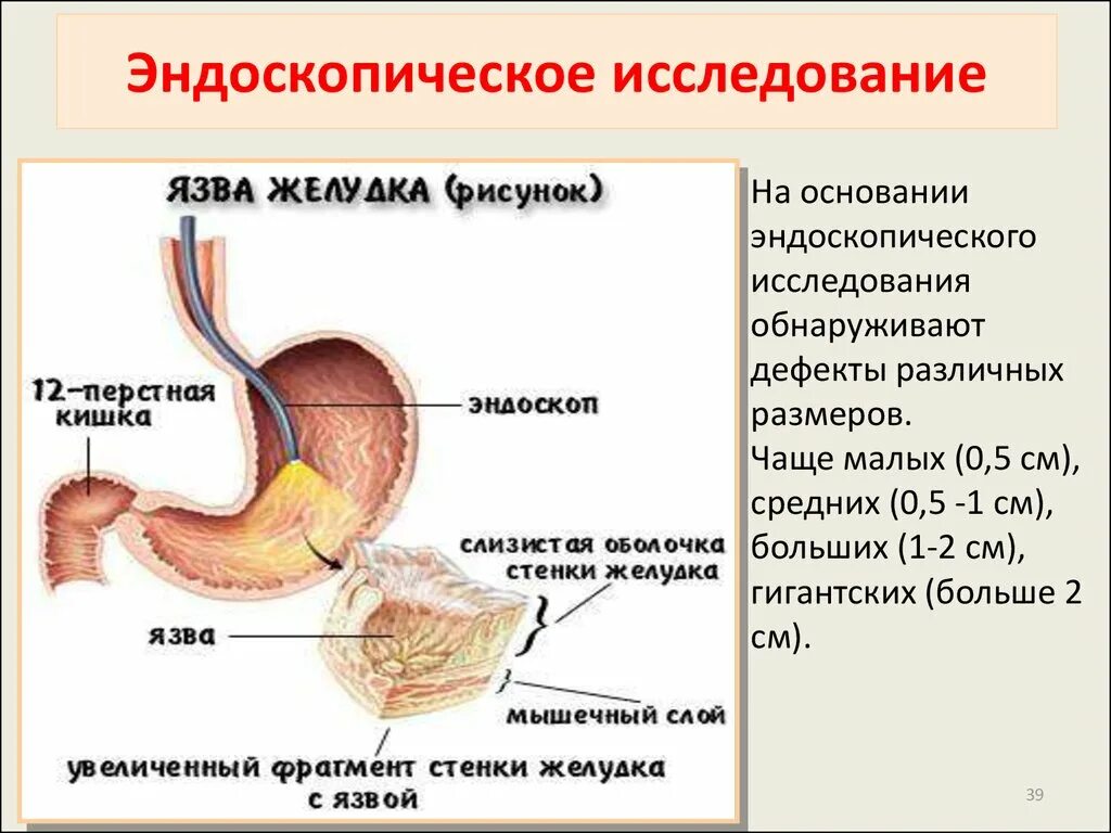 Диагноз заболевание желудка. Терапия язвенной болезни 12 перстной кишки. Язвенная болезнь желудка и 12 перстной. Основные симптомы язвенной болезни желудка и 12-перстной кишки. Язвенная болезнь 12 перстной кишки симптомы.