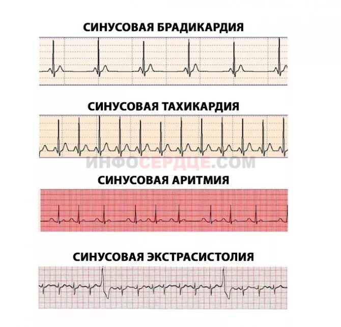 Тахикардия у ребенка 10 лет. Синусовая тахикардия синусовая брадикардия. синусовая тахикардия сердца экг. синусовая аритмия на экг. тахикардия у подростка.