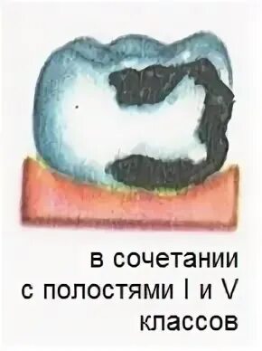 Препарирование кариозных полостей 2 класса по блэку