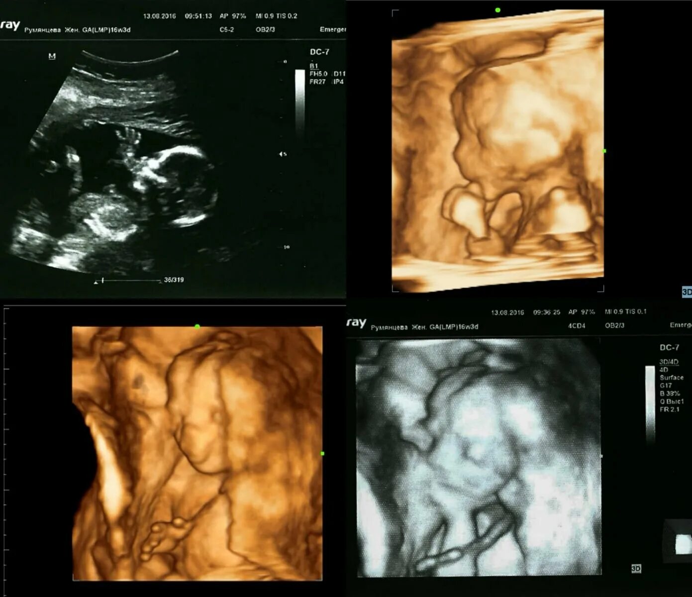 Плод 16 недель беременности УЗИ плода. УЗИ 15-16 недель беременности. УЗИ 16 недель беременности. Снимки УЗИ на 16 неделе беременности.