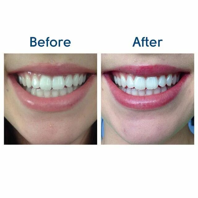Перед отбеливанием. Opalescence go отбеливание. Opalescence отбеливание улыбка. Отбеливание зубов до и после. Отбеливание зубов Opalescence до и после.