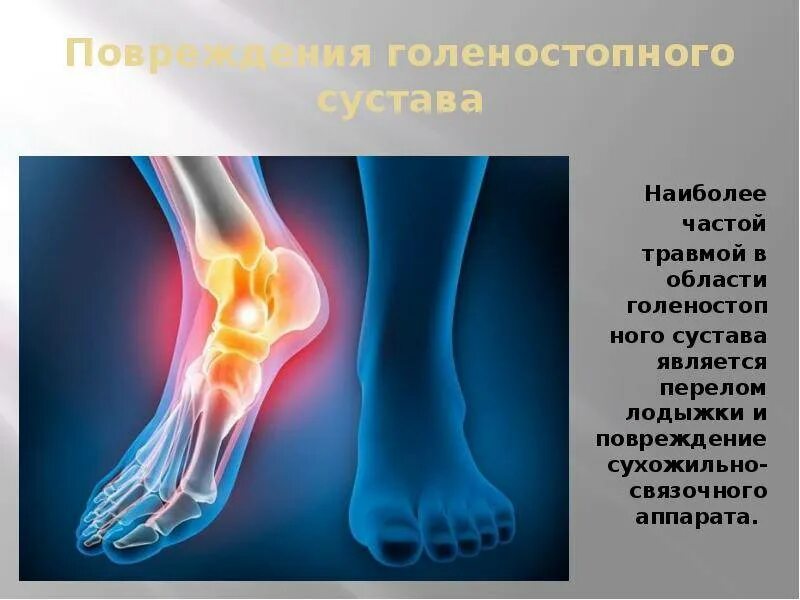 Вывих растяжение голеностопа. Гемартроз голеностопного сустава. подвывих голеностопного сустава гематома. переломы голеностопного сустава супинационные.