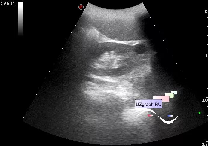 Кальцинат в печени на узи. Сонография желчного пузыря.