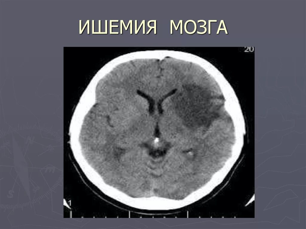 Очаг ишемии мозга. Ишемический инсульт на кт головного мозга. Ишемический инсульт снимок кт. Кт мозга при хронической ишемии головного мозга. Ишемический инсульт мрт.