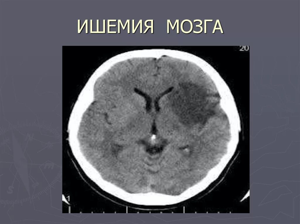 Лекарство от ишемии мозга. Ишемический инсульт на кт головного мозга. Ишемический инсульт снимок кт. Кт мозга при хронической ишемии головного мозга. Ишемический инсульт мрт.