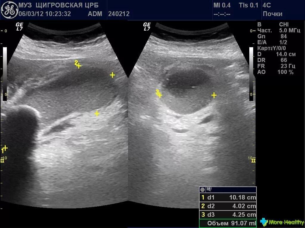 Инфильтрат желчного пузыря. Камни в желчном пузыре узи. Инфильтрат желчного пузыря. Инфильтрат узи картина. Конкремент в шейке желчного пузыря на узи.