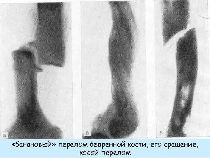 Цементно костная дисплазия. Периапикальная цементно костная дисплазия. Срастание бедренной кости. Остеогенез бедренной кости.