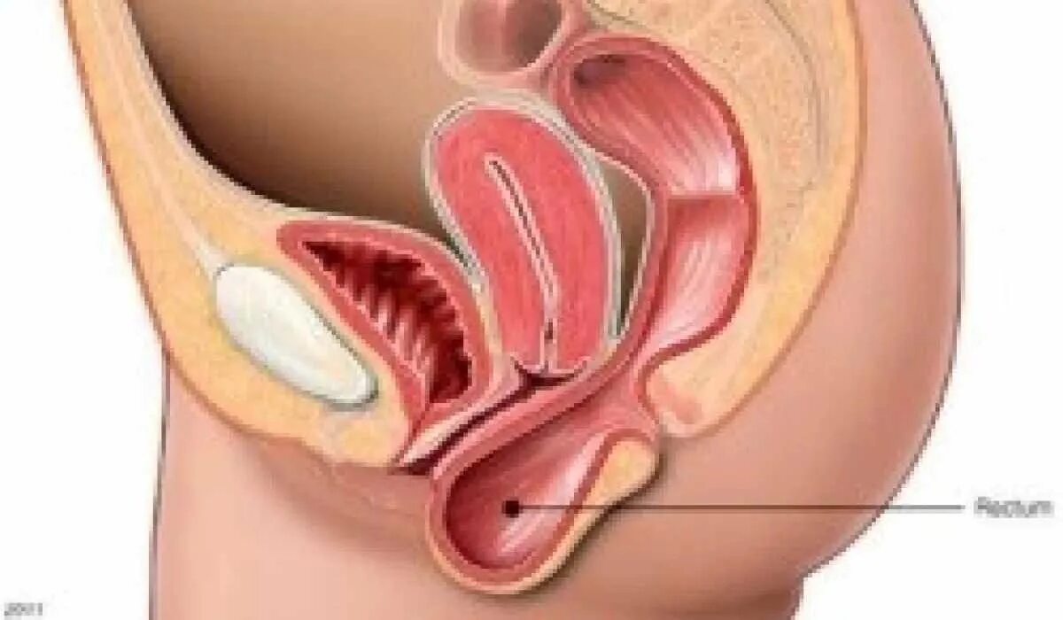 Спорт матка. Опущение матки и стенок влагалища.