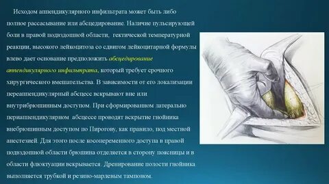 Инфильтрат правой подвздошной