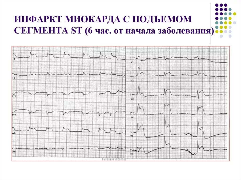 Экг подъем. ЭКГ при инфаркте миокарда с подъемом St. ЭКГ при инфаркте миокарда без подъема сегмента St. ЭКГ острый инфаркт миокарда с подъемом сегмента St. ЭКГ при инфаркте с подъемом ст.