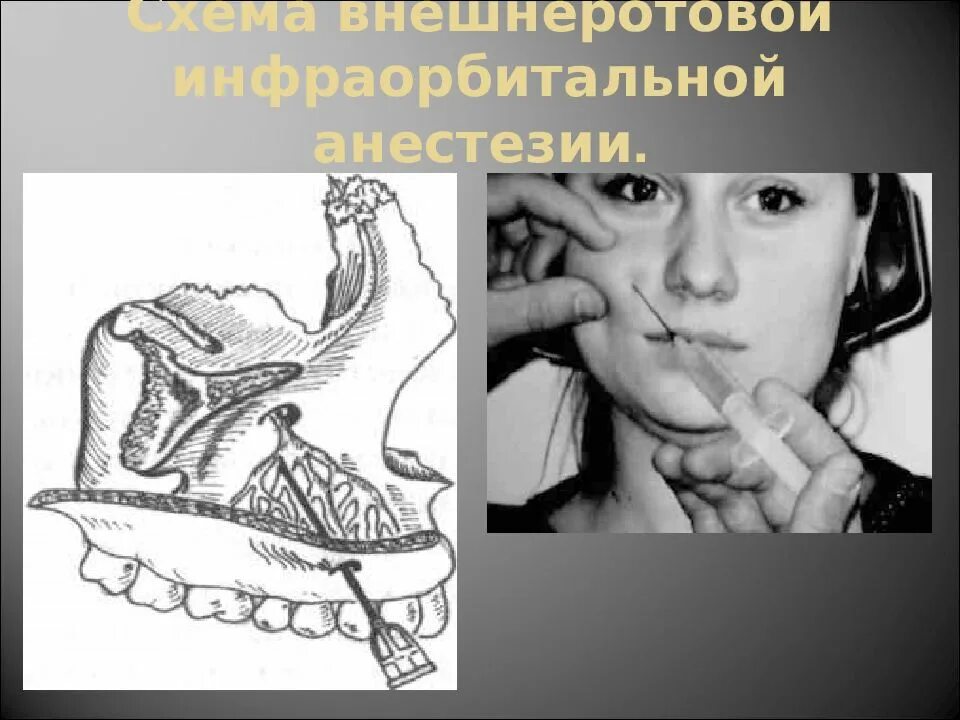 Подглазничная анестезия. Внеротовая инфраорбитальная анестезия. инфраорбитальная анестезия верхней челюсти. туберальная анестезия в стоматологии. инфраорбитальная анестезия методика.