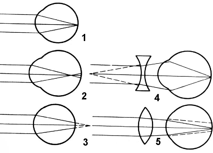 Близорукость и дальнозоркость схема рефракции. Нарушение зрения близорукость дальнозоркость. Дальнозоркость близорукость оптическая схема. Нарушение зрения схема близорукость и дальнозоркость. Нормальный глаз схема