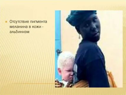 Отсутствие пигмента меланина
