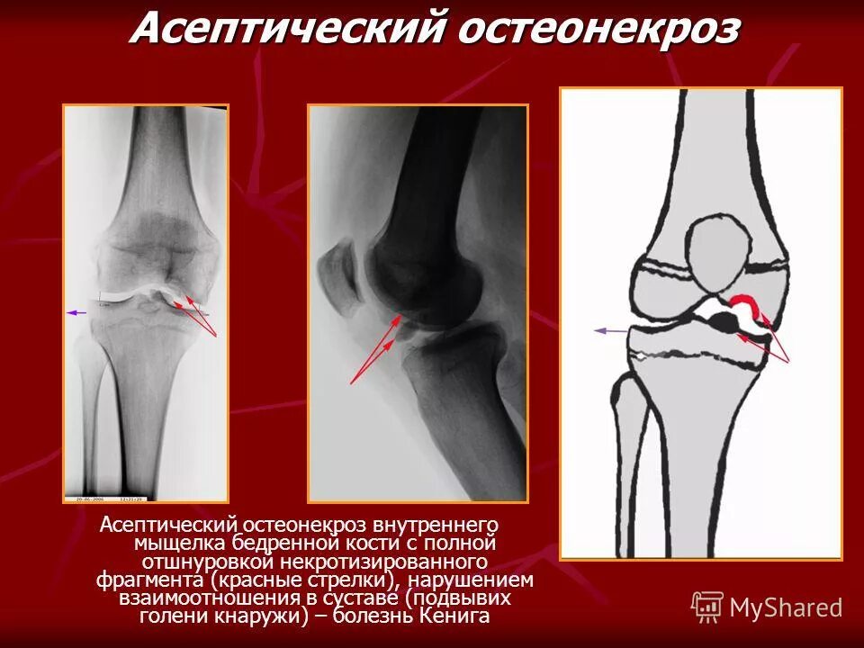 Внутрисуставной перелом большеберцовой кости. Мыщелка тазобедренного сустава. Строение коленного сустава мыщелки. Аневризматическая киста бедренной кости на кт. Внесуставные связки коленного сустава.