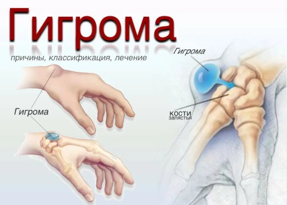 Гигрома запястья (лучезапястного сустава). Шишка на кисти руки гигрома. Uuhjvf. Операции руками как называются