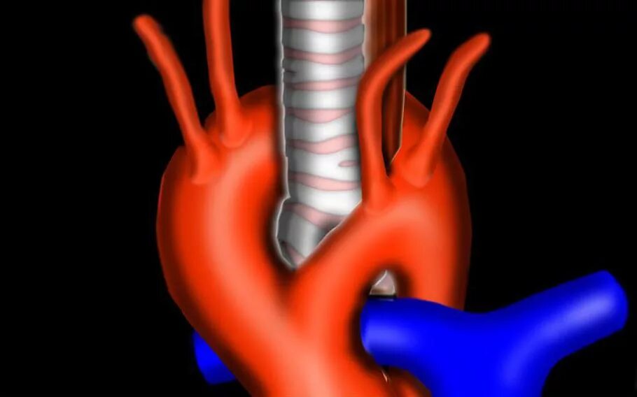 Чем лечить уплотнение аорты сердца. Double aortic arch. аномалия бифуркации аорты.