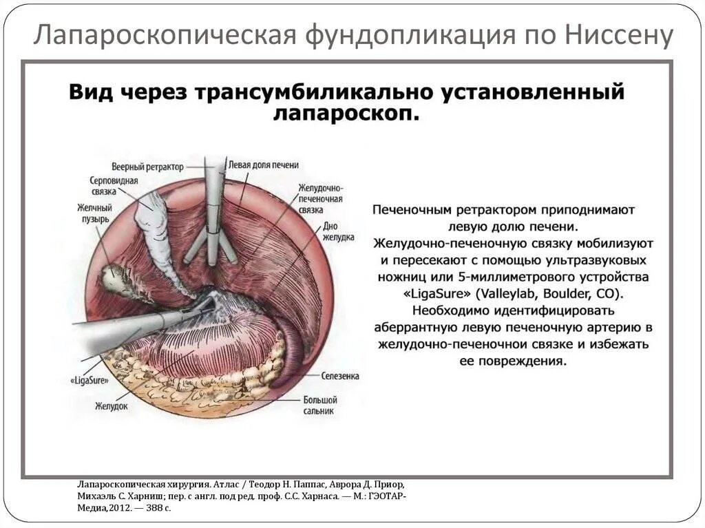 Пищевод отзывы. Устранение грыжи диафрагмы, фундопликация по Ниссену. Фундопластика по Ниссену. Манжета на пищеводе операция.