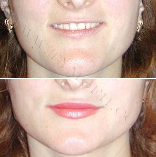 Тонкие губы до и после. Пластика губ хейлопластика контурная. Аугментации губ тонкие губы 1 мл. Гиалуроновая кислота 0. Булхорн, хейлопластика и корнер лифт.