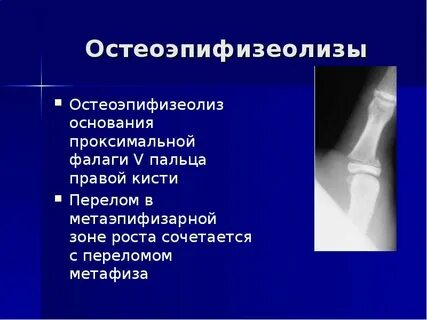 Эпифизеолиз лечение