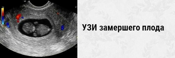 Снимок УЗИ замершего плода. Замершая беременность УЗИ.