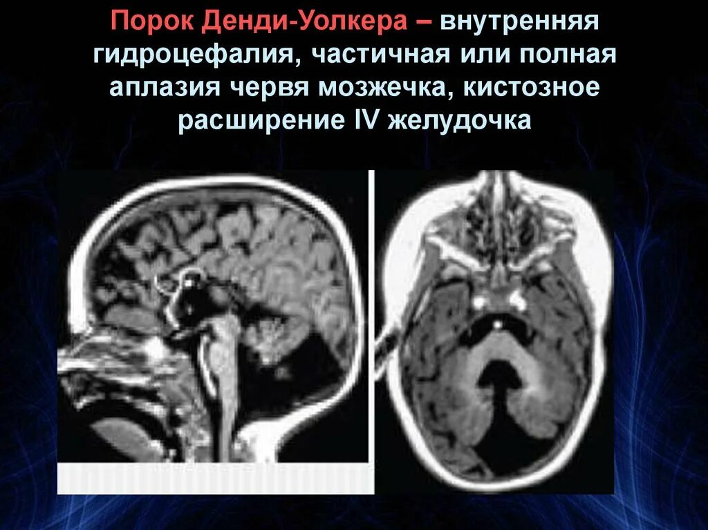 Гипоплазия червя. Гипоплазия миндалин мозжечка мрт. Врожденные пороки развития мозжечка. ВПР ЦНС гипоплазия червя мозжечка.