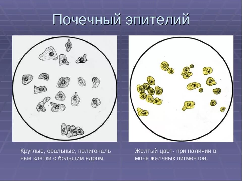 Дрожжевые клетки в моче повышены. Плоский и почечный эпителий. Микроскопия мочи клетки почечного эпителия. Почечный эпителий жироперерожденный. Микроскопия мочи эпителий плоский.