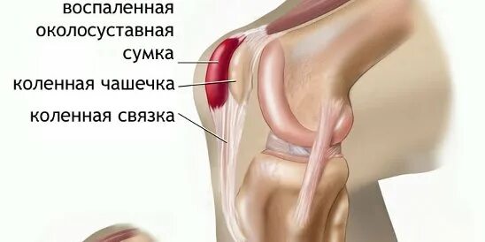 Если болит чашечка колена. Колено сбоку на косточке болит. Чашечка коленного сустава. Болит под коленной чашечкой при надавливании. Если болит чашечка колена.
