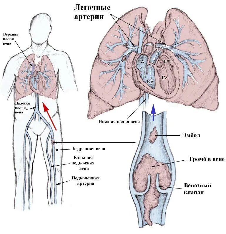 Тромбофлебит легких. Тромбофлебия легочной артерии. Эмболия легочной артерии механизм. Легочная артерия и легочная Вена.