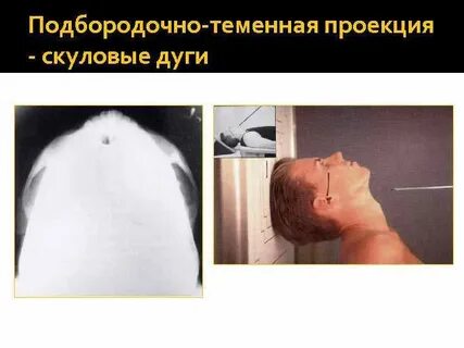 Укладки кости