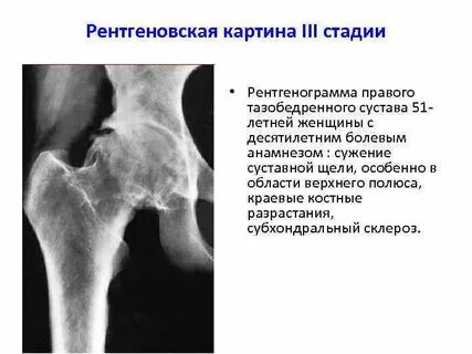Суставная щель тазобедренного сустава неравномерно