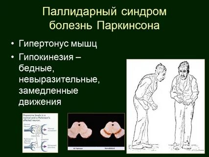 Формы болезни паркинсона