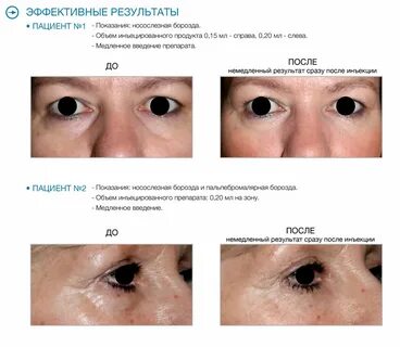 Филлеры глаза отзывы