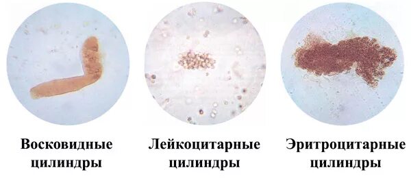 Повышенные цилиндры в моче. Эритроцитарные цилиндры в моче. Лейкоцитарные цилиндры в моче. Зернистые и восковидные цилиндры. Гиалиновый цилиндр в осадке мочи.