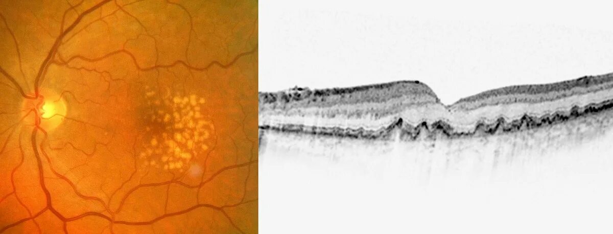 Лечение дегенерации макулы