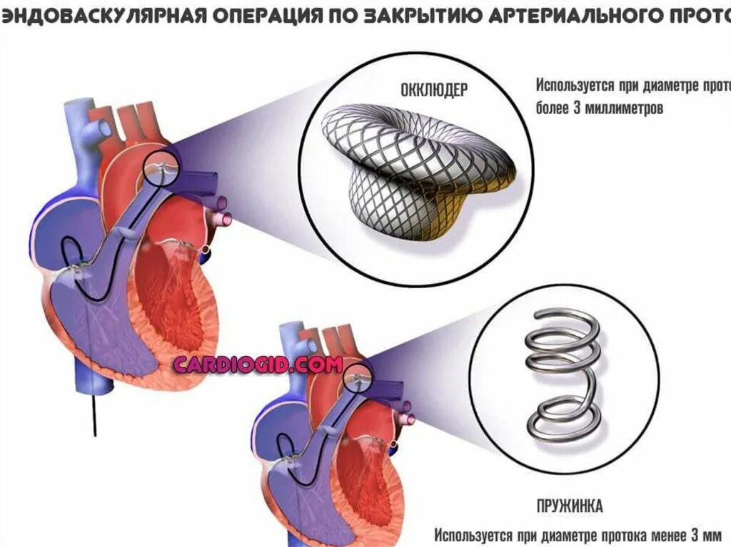 Окклюдер открытого артериального протока. Операцию при открытом артериальном протоке (ОАП) проводят. Открытый артериальный проток окклюдер. Открытый боталлов проток операция. Как клапан делает операция