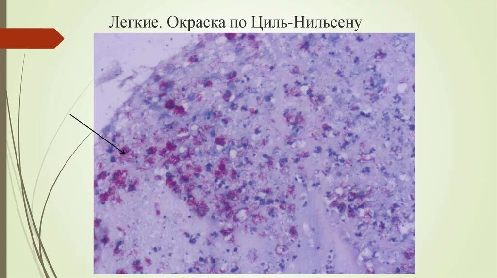 Микроскопия по Цилю Нильсену туберкулез. Окраска по Цилю Нильсену. Циль Нильсену окраска.