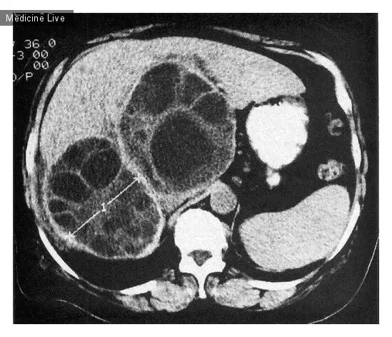 Паразитарная киста печени. Кисты печени кт эхинококкоз. Паразитарные кисты печени кт.