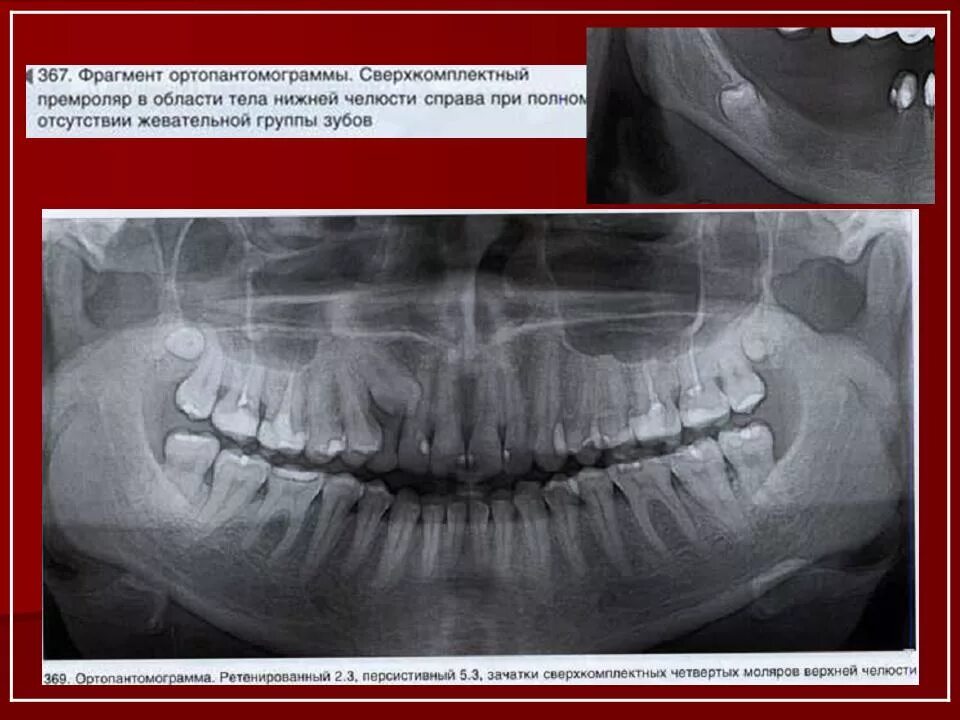 Аномалии удаления. Сверхкомплектные зубы ОПТГ. Сверхкомплектный зуб клык. Сверхкомплектные зубы на нижней челюсти. Ретинированный сверхкомплектный зуб.
