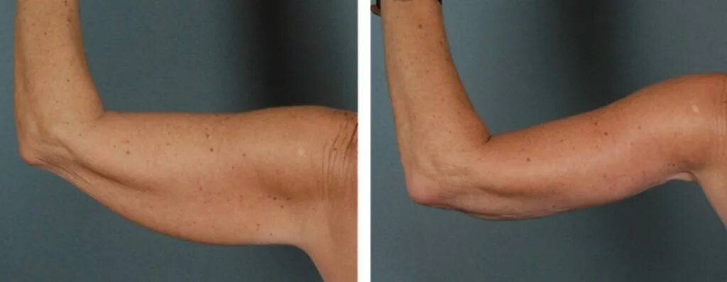 Липосакция плеч до и после отзывы Speedy Liposuction Young Clinic
