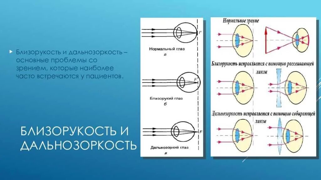 Улучшение зрения дальнозоркость. Глаз дальнозоркость и близорукость. схема близорукости и дальнозоркости. миопия и гиперметропия. строение глаза близорукость и дальнозоркость.