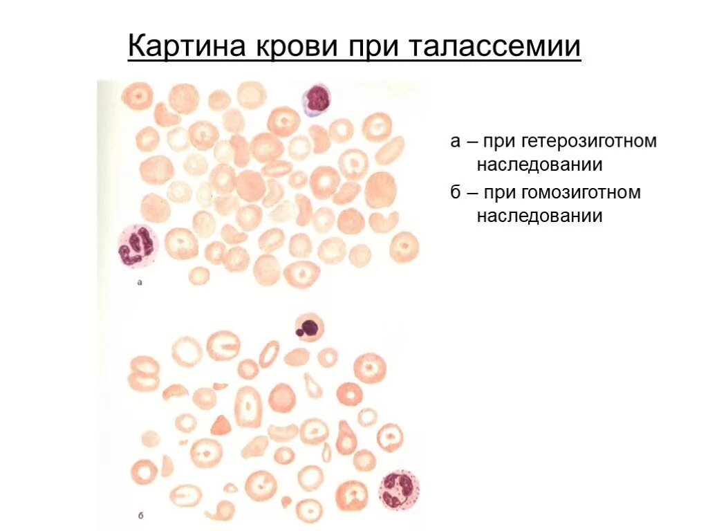 Относительная анемия. Талассемия картина крови. Талассемия картина крови периферической. Картина периферической крови при талассемии.