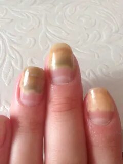 Ногти отслаиваются от кожи