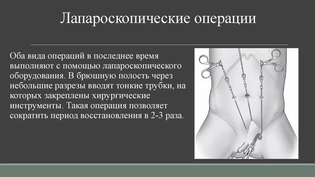 Лапароскопические операции при крипторхизме. Лапароскопические операции виды. Операции при крипторхизме виды. Крипторхизм лечение